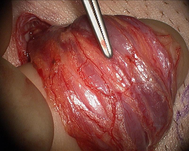 Microsurgical Varicocelectomy by Dr. Daniel Williams