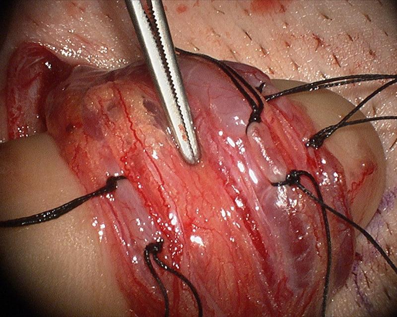 Microsurgical Varicocelectomy by Dr. Daniel Williams